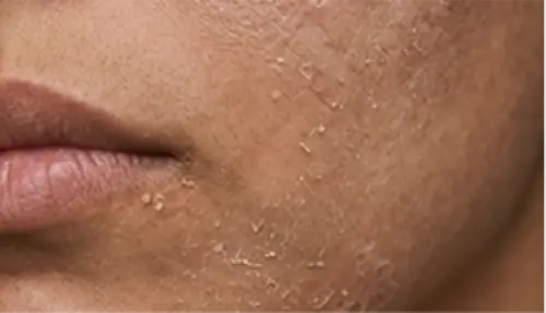 جلد ميت وخشونة على البشرة